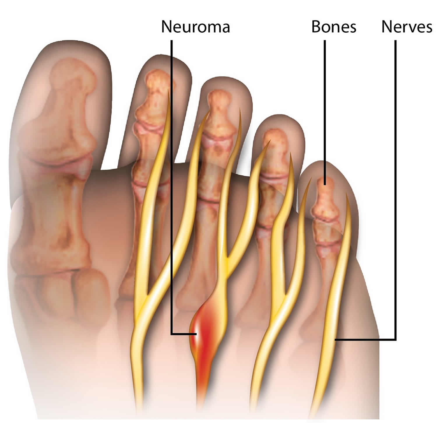 LE NEVROME DE MORTON : ÉTIOLOGIE, DIAGNOSTIC ET APPROCHES THERAPEUTIQUES