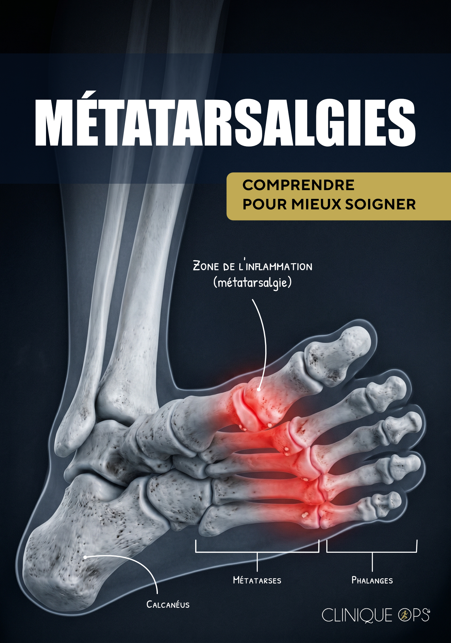 M&eacute;tatarsalgies : comprendre la douleur de l&rsquo;avant-pied pour mieux la traiter