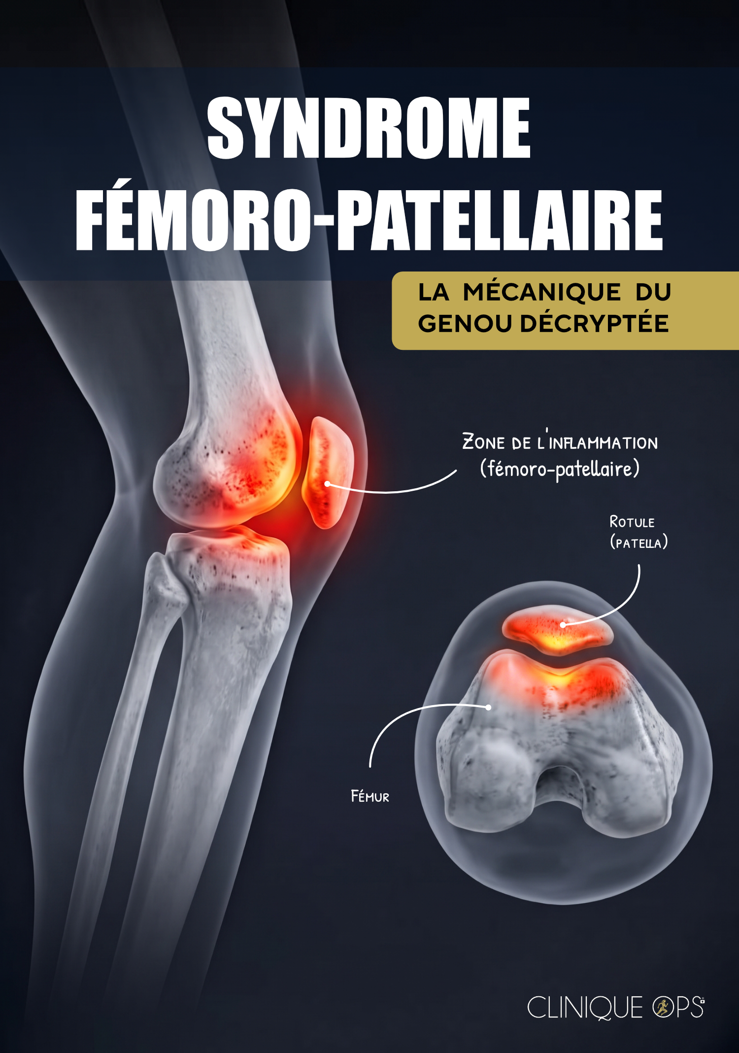 Syndrome f&eacute;moro-patellaire : quand la douleur de la rotule raconte le mouvement du membre inf&eacute;rieur