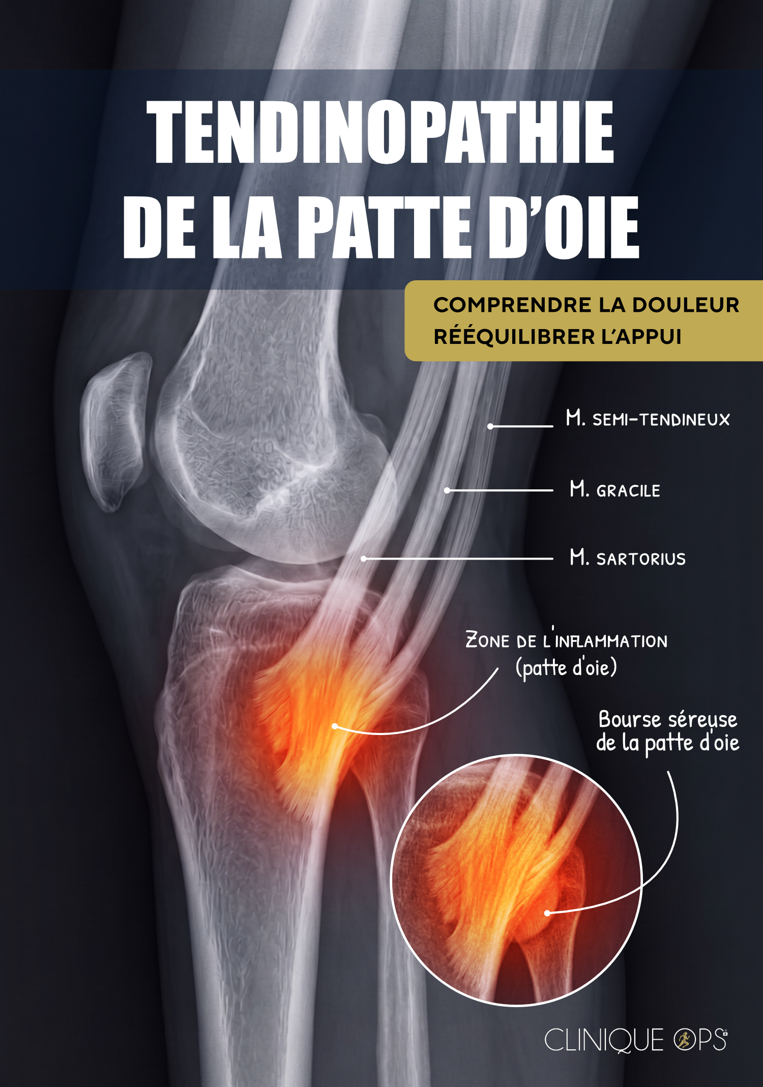 Tendinopathie de la patte d&rsquo;oie : quand une douleur interne du genou r&eacute;v&egrave;le un d&eacute;s&eacute;quilibre du mouvement